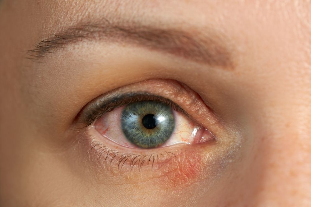Finding the Right Specialist for Demodex Blepharitis
